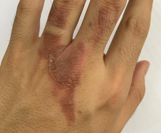 油刺原因與治療