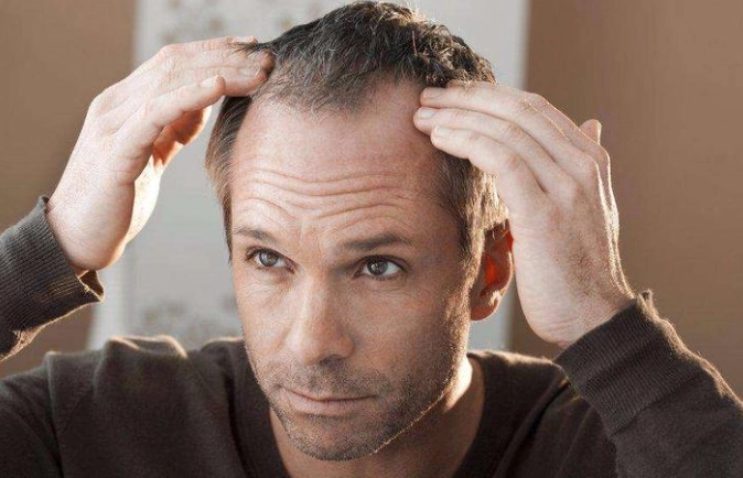 男性掉髮年齡 男性掉髮年齡