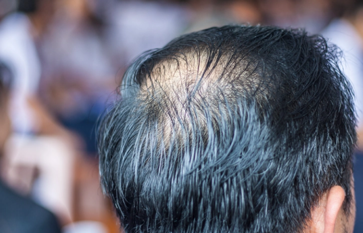 雄性禿成因 雄性禿成因