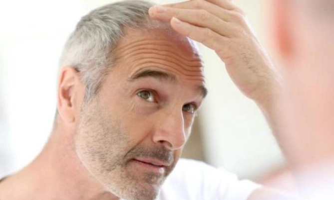 男生禿頭年齡 男生禿頭年齡