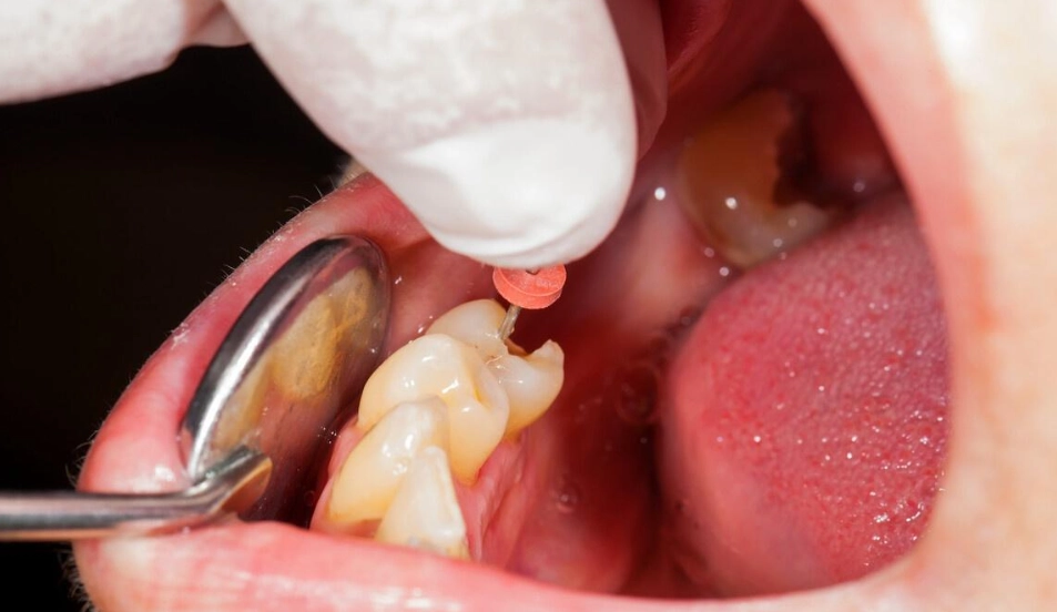 牙線正確使用方法