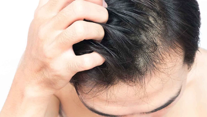 男生禿頭年齡 男生禿頭年齡