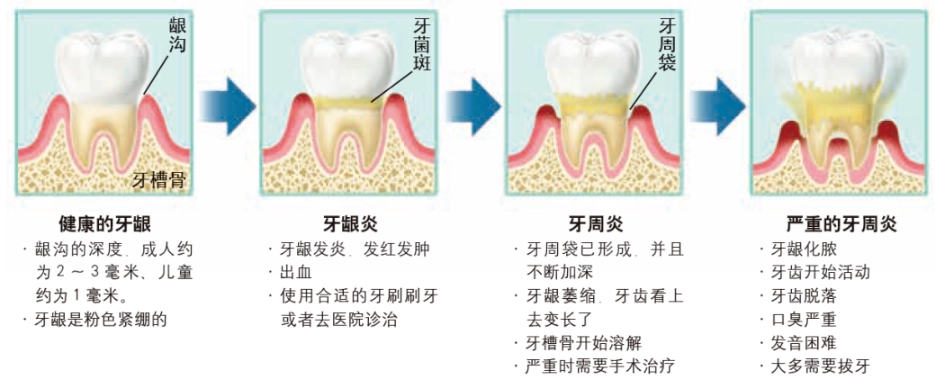 牙菌膜预防 牙菌膜预防
