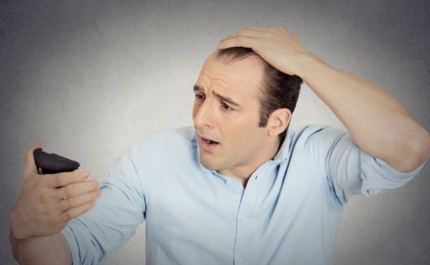 男性掉髮因素 男性掉髮因素