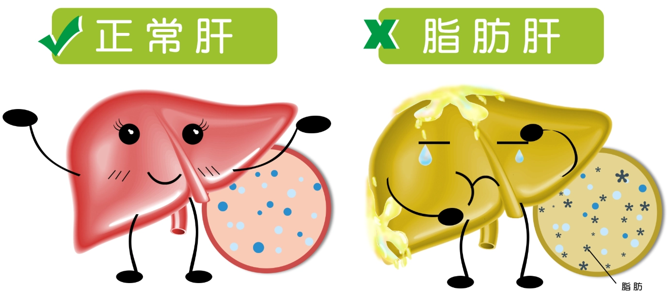 脂肪肝中醫治療