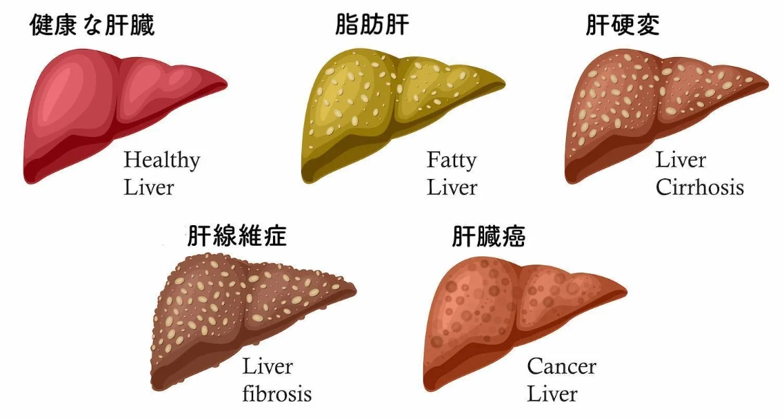 脂肪肝中醫治療