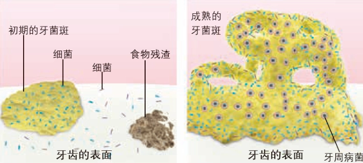 牙菌膜清除 牙菌膜清除