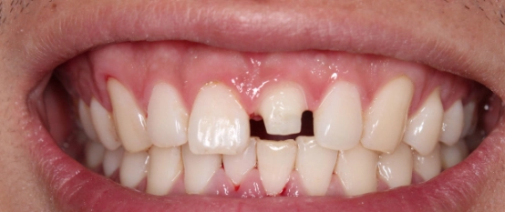 牙線正確使用方法