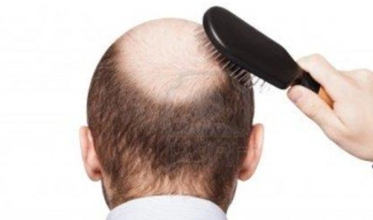 男生禿頭年齡 男生禿頭年齡