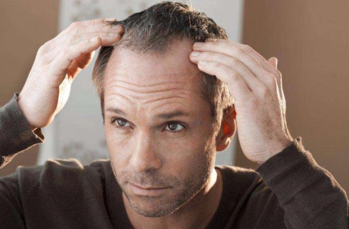 男性掉髮因素 男性掉髮因素
