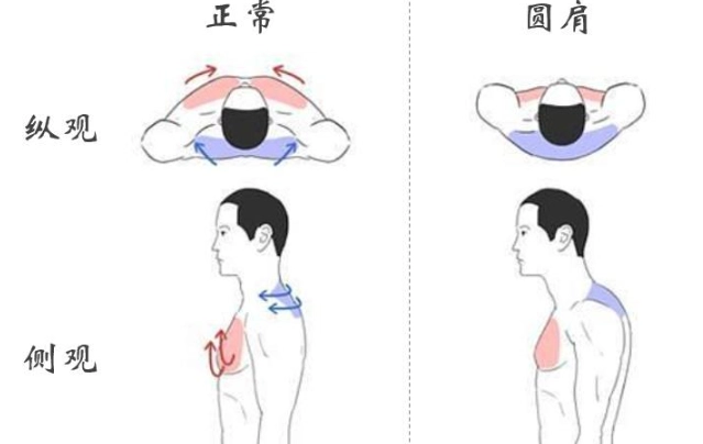 圓肩矯正 圓肩矯正