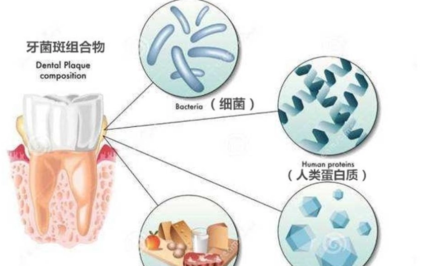牙菌膜清除 牙菌膜清除