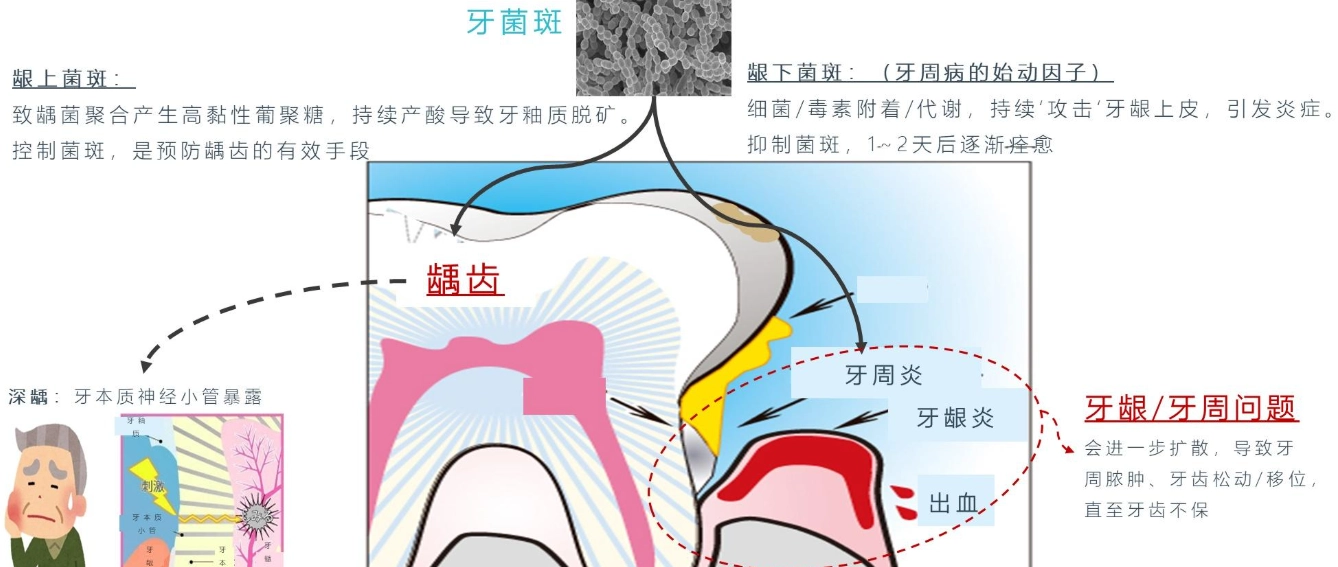 牙菌膜清除方法