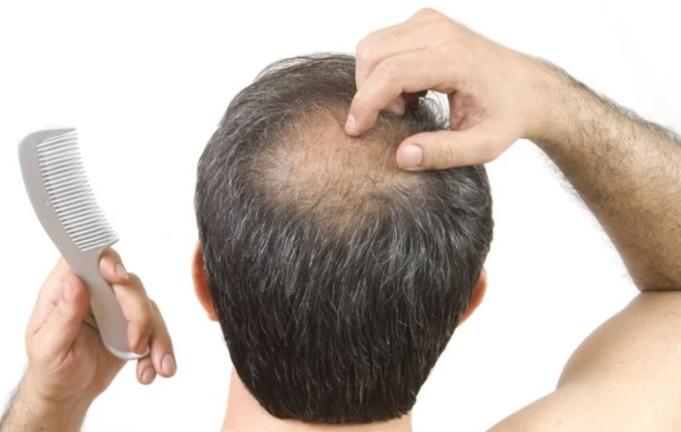 雄性禿成因 雄性禿成因