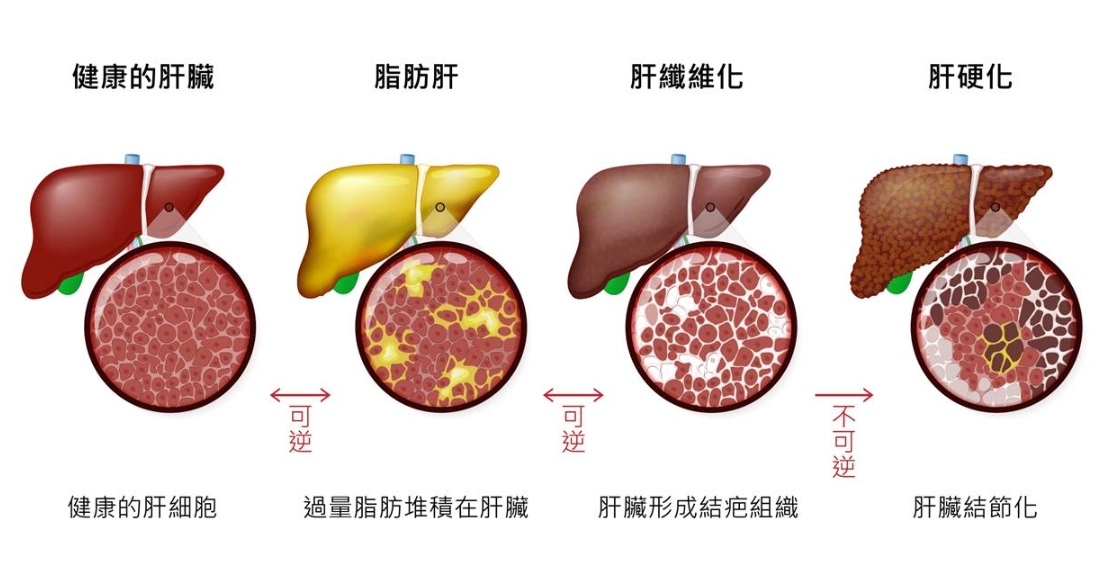 脂肪肝中醫治療