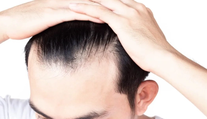 男性掉髮年齡 男性掉髮年齡