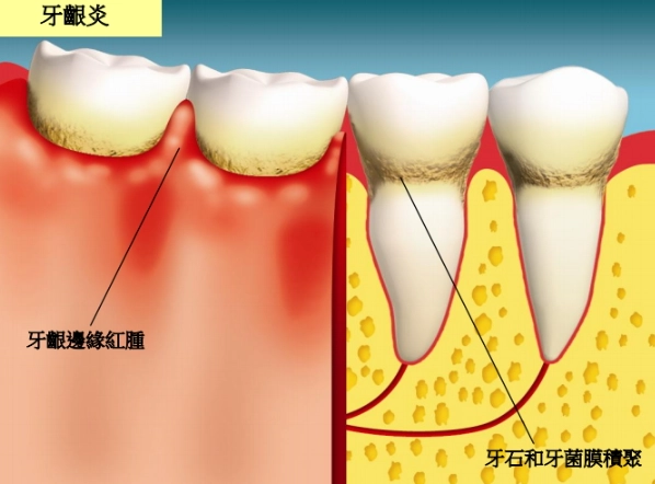 牙菌膜预防 牙菌膜预防