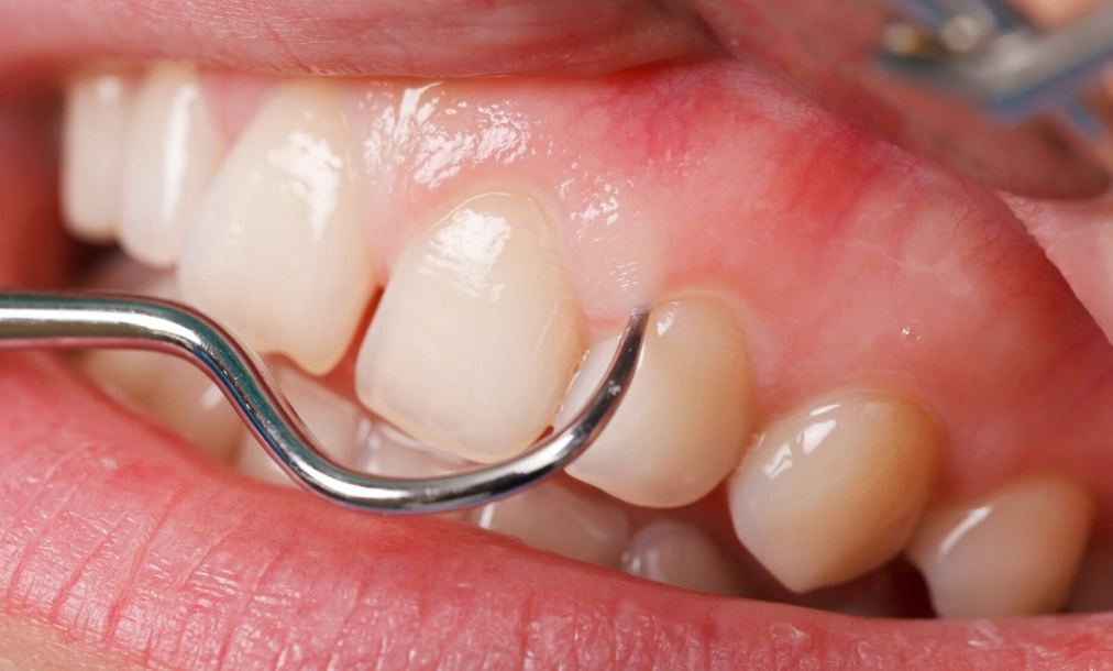 牙線正確使用方法