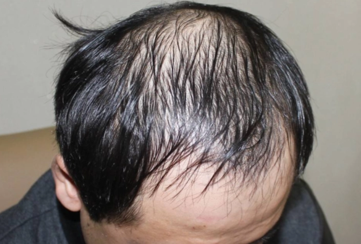 男性秃头早期症状