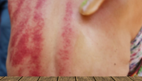 刮痧喝酒禁忌 刮痧喝酒禁忌