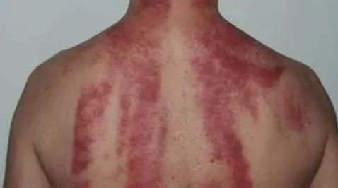 飲酒後刮痧安全嗎 飲酒後刮痧安全嗎