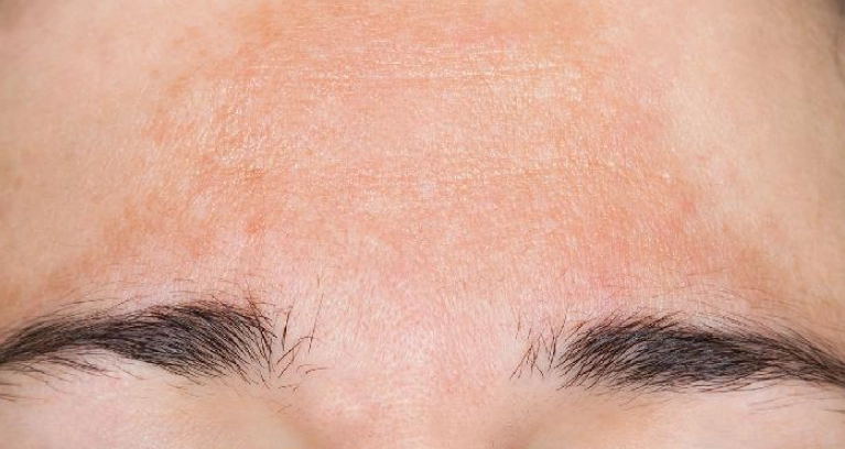 色斑去除 色斑去除