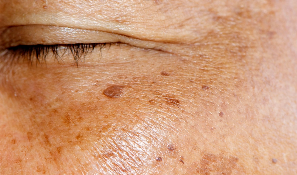 色斑去除 色斑去除