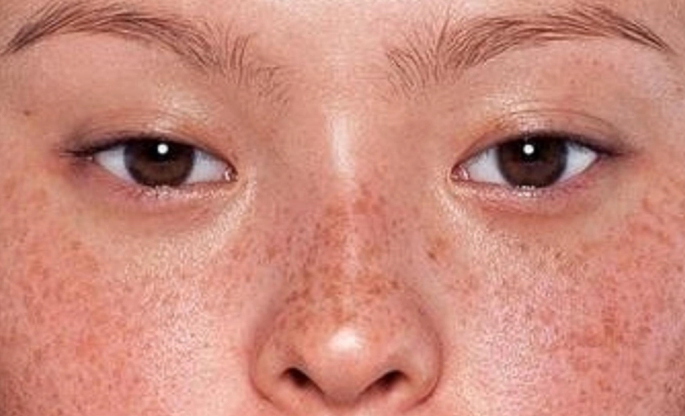 淡斑方法 淡斑方法