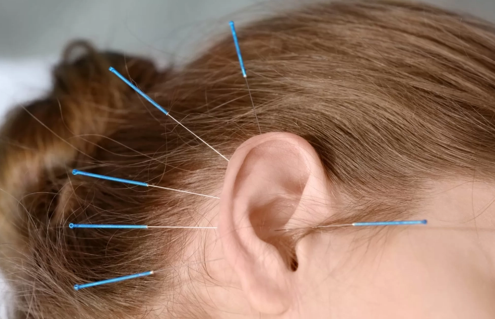 耳鳴針灸治療時間