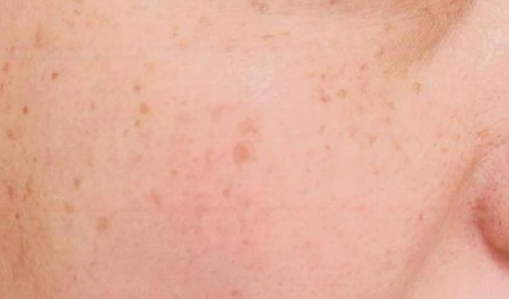 咖啡色斑塊治療 咖啡色斑塊治療