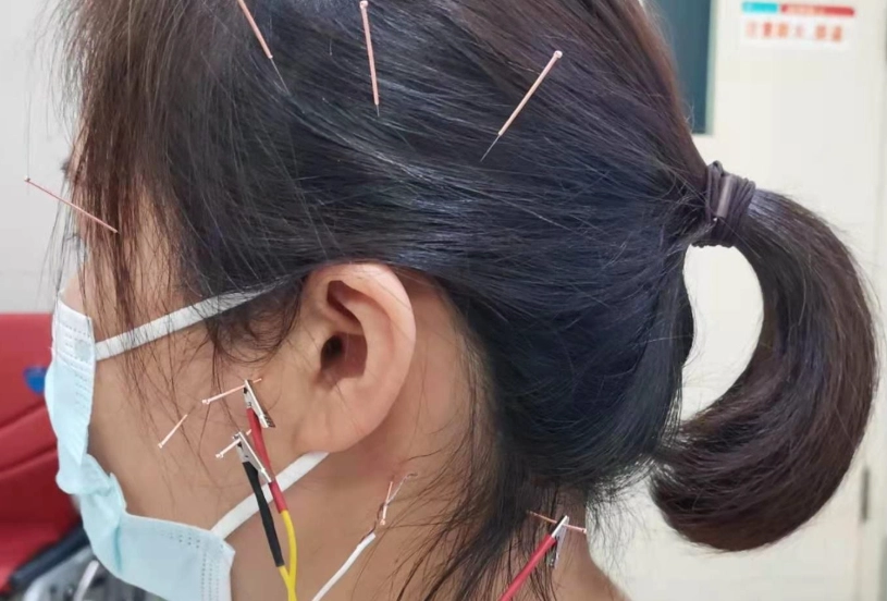 耳鳴針灸