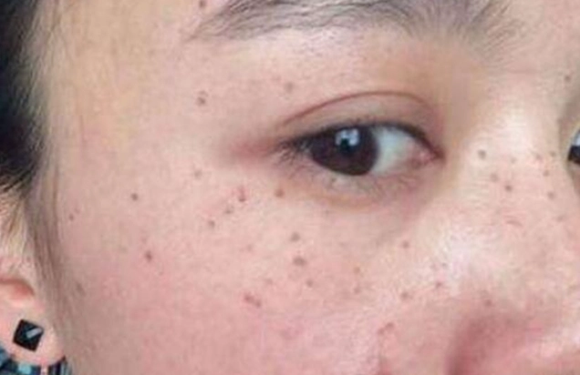 脸上斑点变大