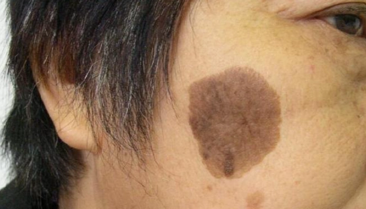 肝斑治療 肝斑治療