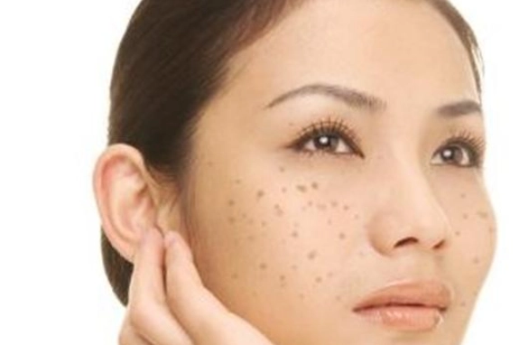 黑斑去除 黑斑去除