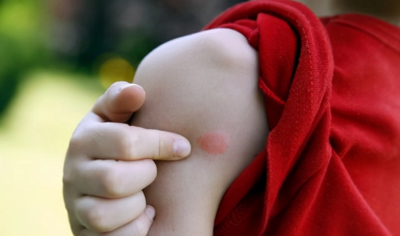 蚊子叮咬症狀 蚊子叮咬症狀