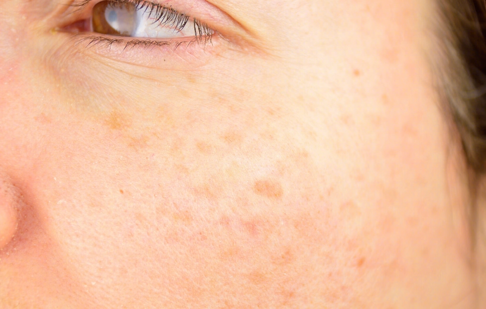 壓力斑成因 壓力斑成因