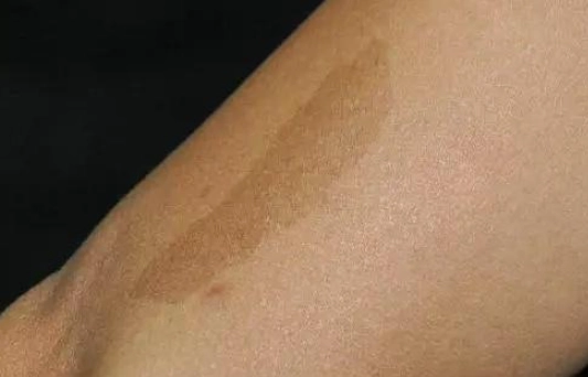 皮膚色素沉澱 皮膚色素沉澱