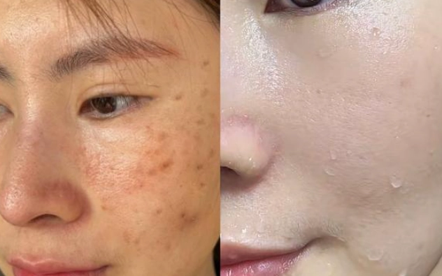 有效祛斑技巧 有效祛斑技巧