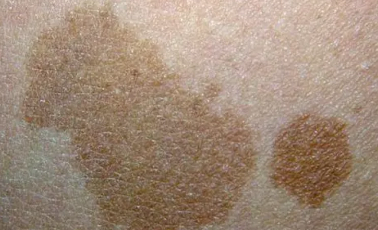 咖啡色斑塊治療 咖啡色斑塊治療