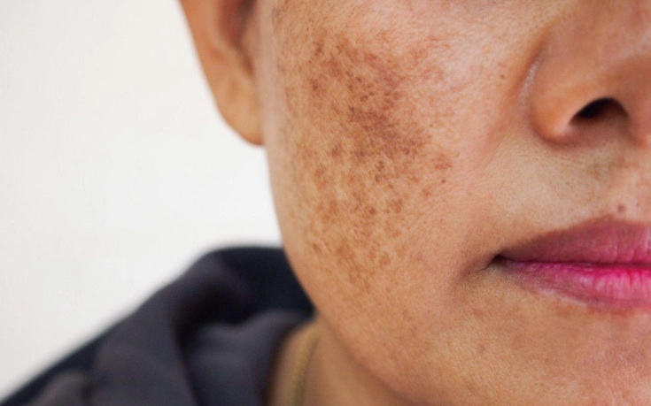 皮膚色素沉澱 皮膚色素沉澱