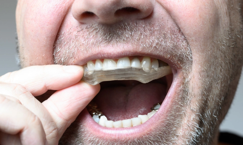 夜間磨牙治療 夜間磨牙治療