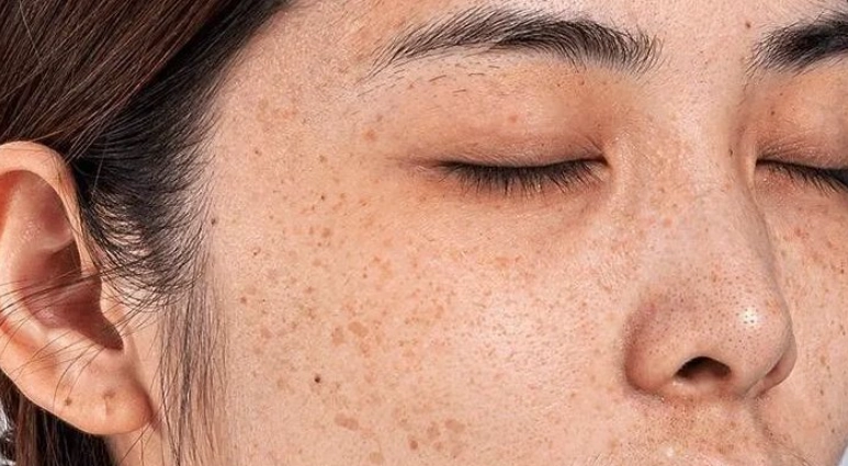 壓力斑治療 壓力斑治療