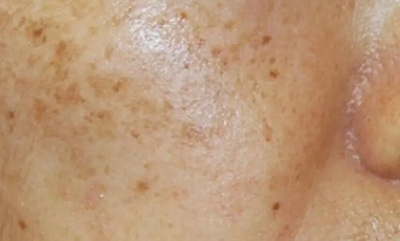 壓力斑成因 壓力斑成因