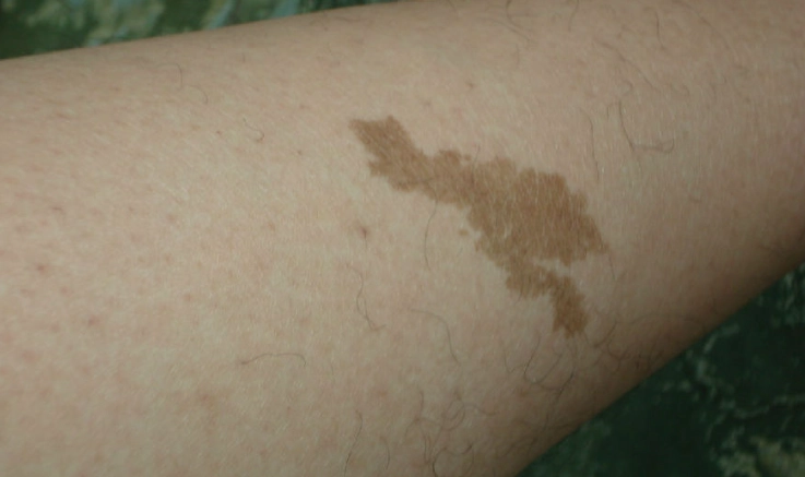 皮膚色素沉澱 皮膚色素沉澱