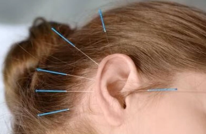 中醫針灸耳鳴