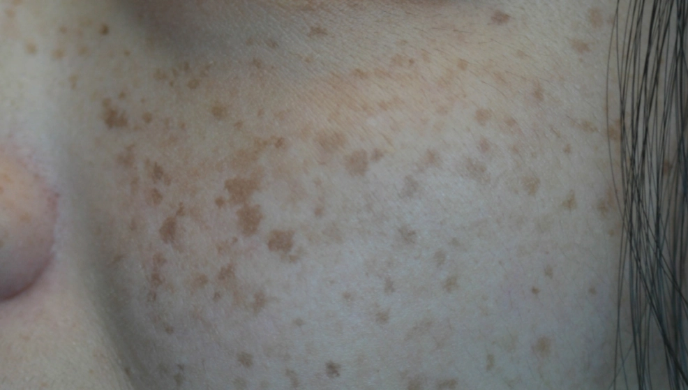 色素沉澱治療 色素沉澱治療