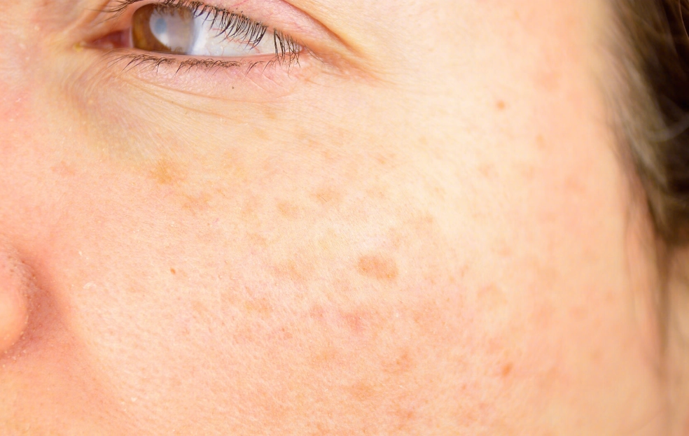 脸上斑点变大