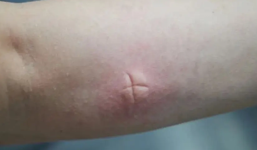 蚊子叮咬肿胀原因