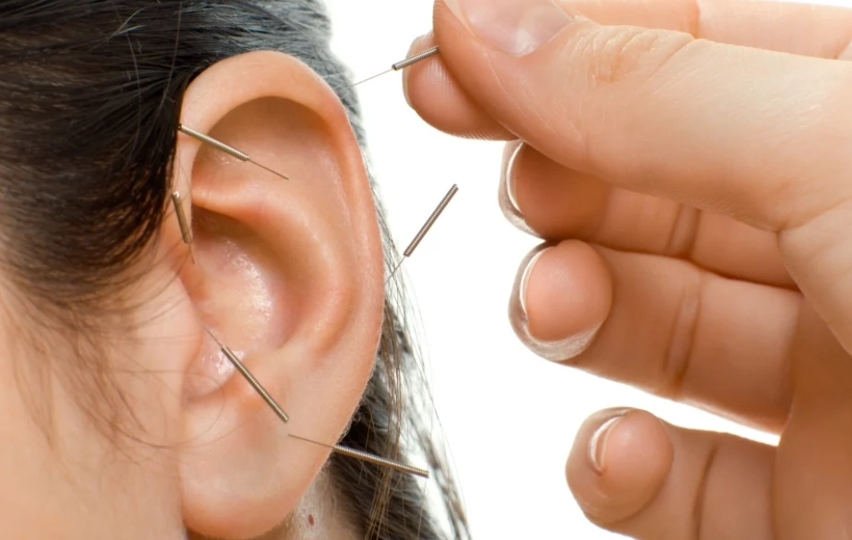 針灸治療耳鳴