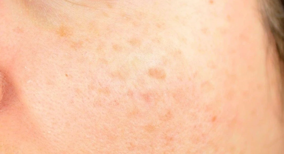 斑點去除方法 斑點去除方法